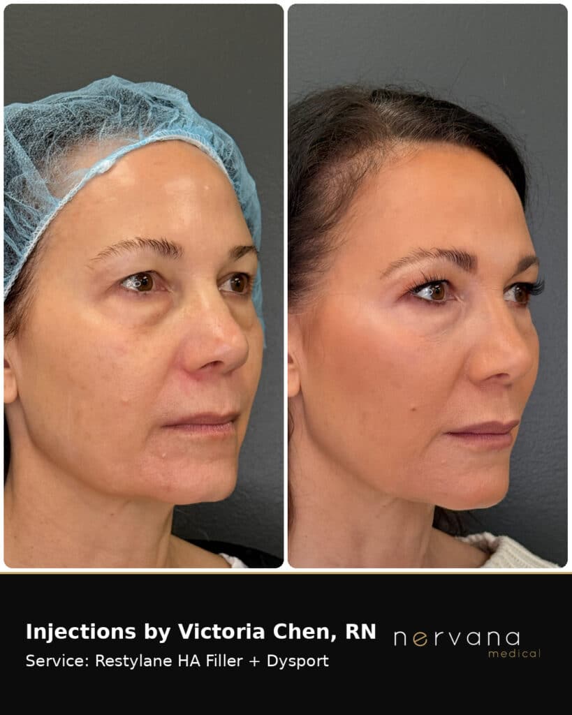 Before and After Image: Restylane + Dysport Facial Before & After | Sandy UT - front