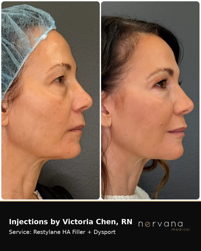 Before and After Image: Restylane + Dysport Facial Before & After | Sandy UT - front