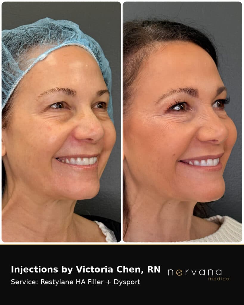 Before and After Image: Restylane + Dysport Facial Before & After | Sandy UT - front