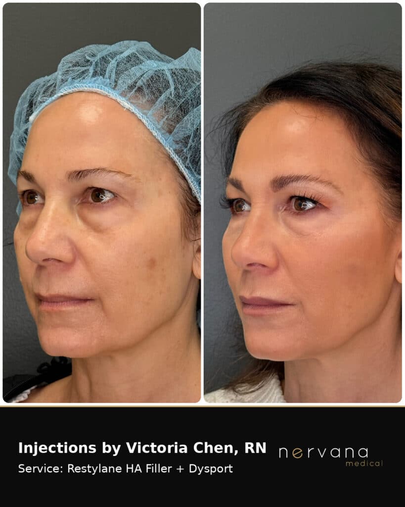 Before and After Image: Restylane + Dysport Facial Before & After | Sandy UT - front