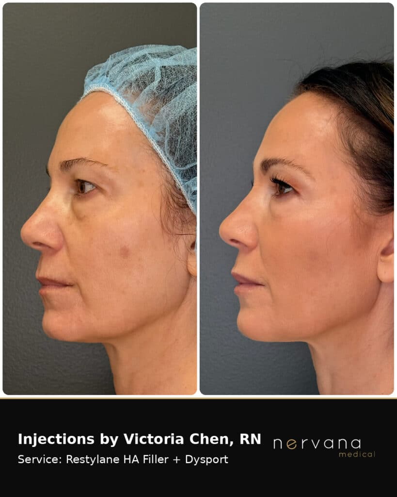 Before and After Image: Restylane + Dysport Facial Before & After | Sandy UT - front