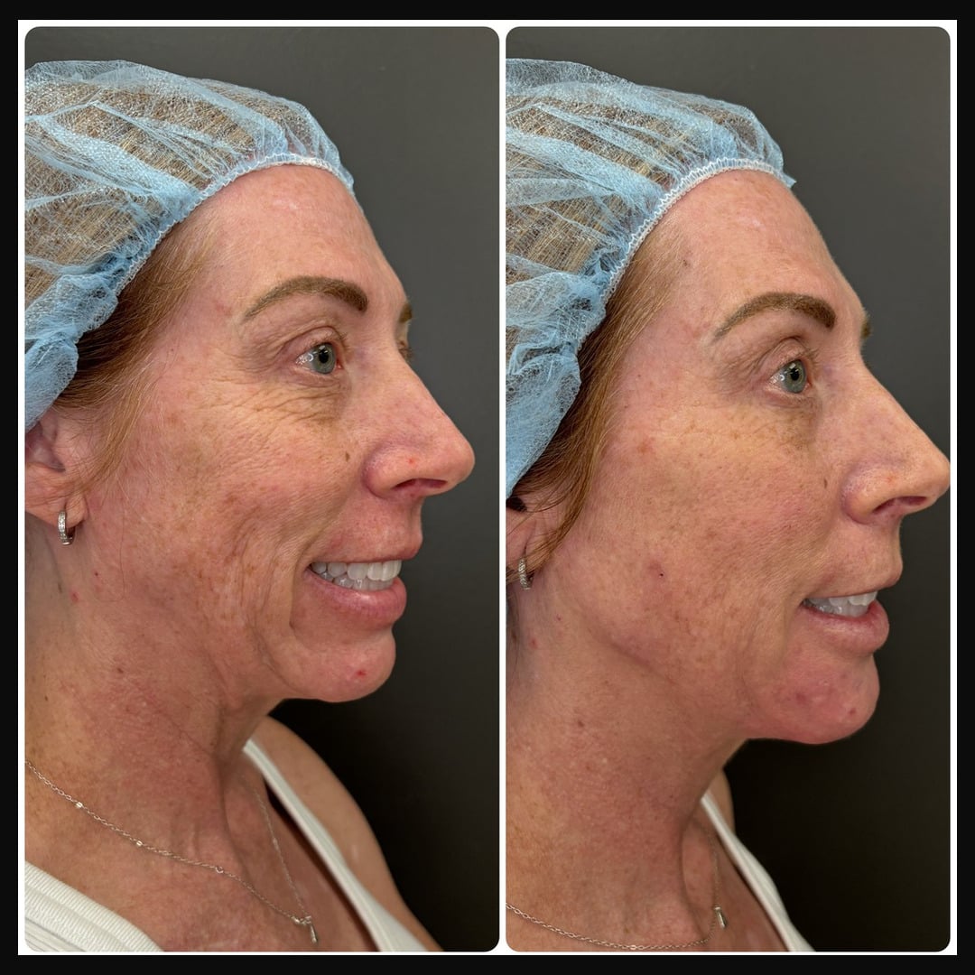 Chin and jawline filler before and after