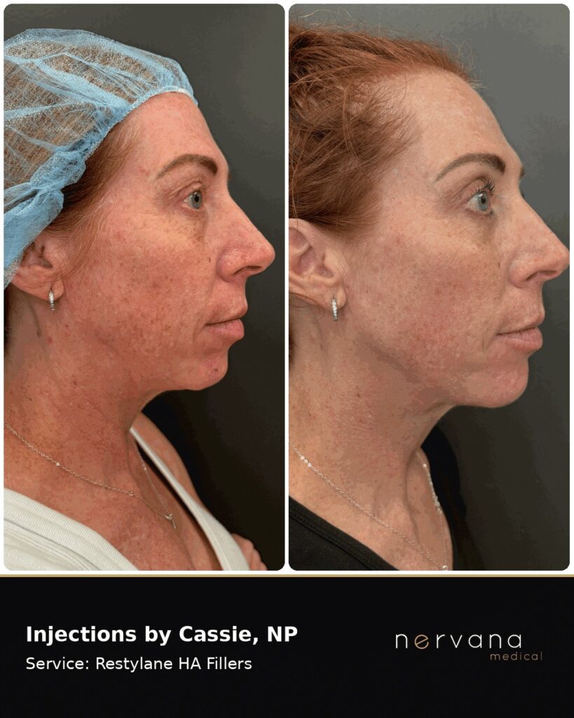 Before and After Image: Restylane Chin Filler Before & After | Sandy UT - right-side