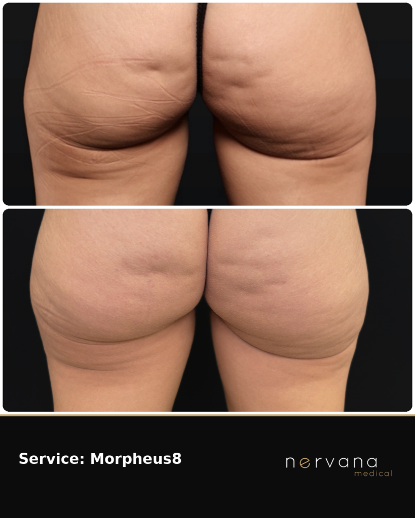 Before and After Image: Morpheus8 Body Before and After: Buttocks & Thighs | Sandy, UT - back