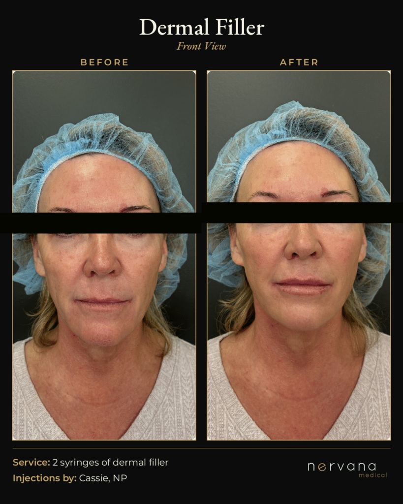 Before and After Image: Dermal Filler Before and After Sandy UT: 2 Syringes, Natural Results - front