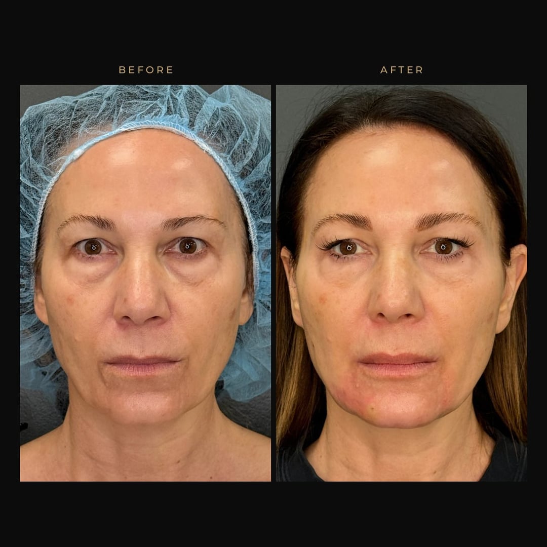 Full-face filler and Dysport before and after
