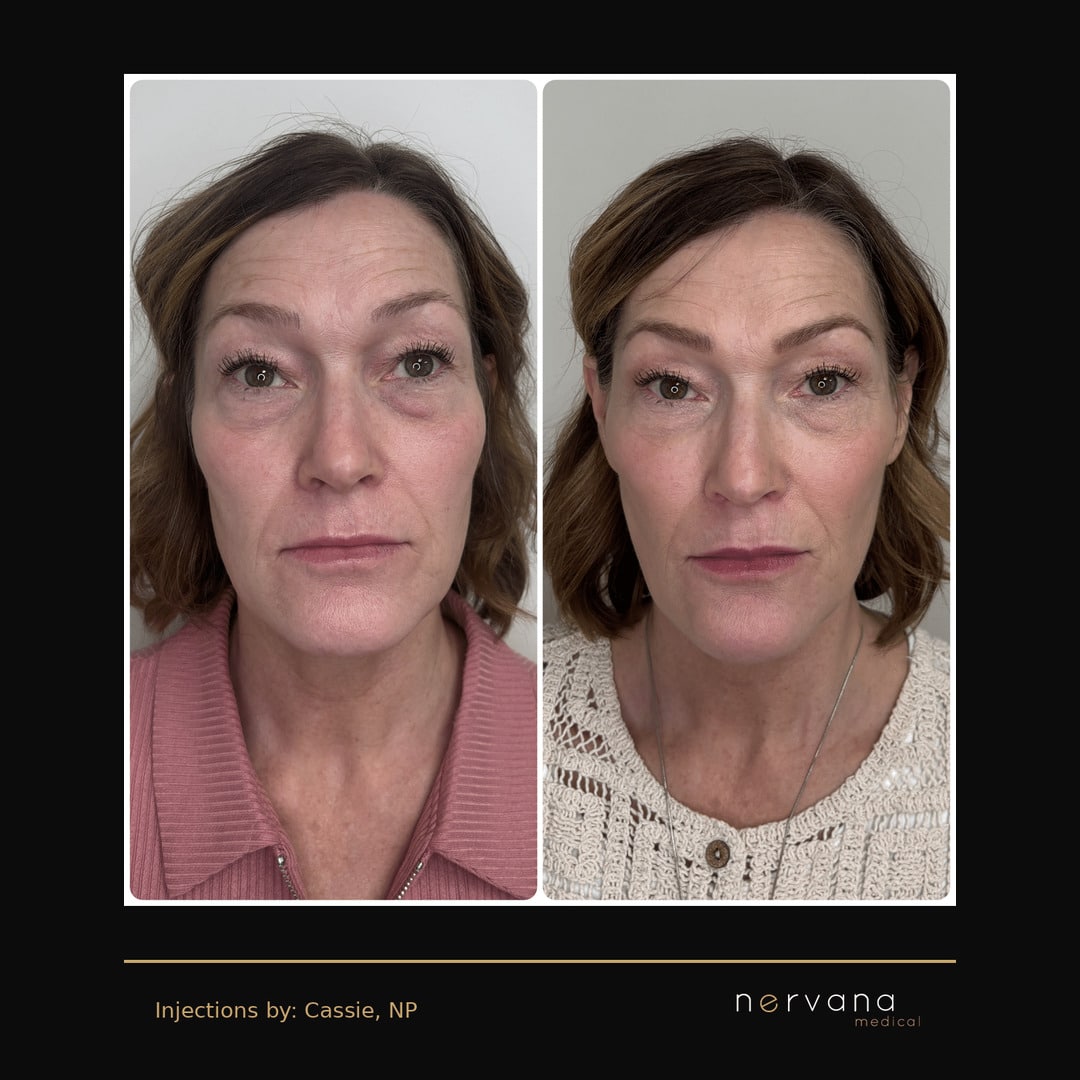 Full-face Restylane filler before and after, front view