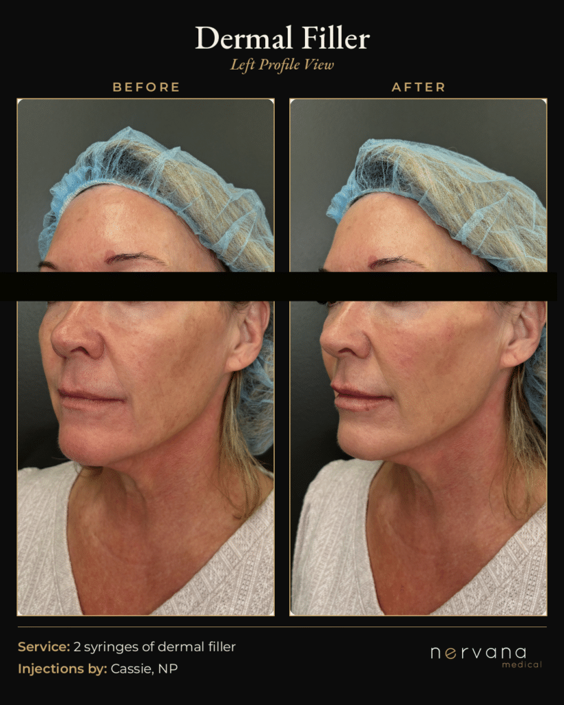 Before and After Image: Dermal Filler Before and After Sandy UT: 2 Syringes, Natural Results - left-side
