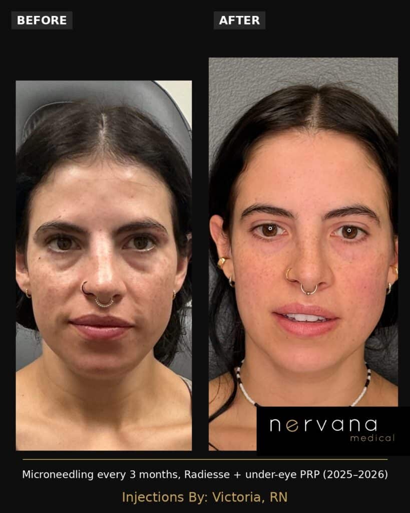 Before and After Image: Microneedling Before and After Sandy UT: Radiesse and PRP Results - front