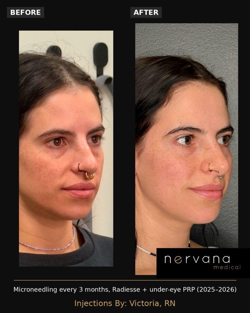 Before and After Image: Microneedling Before and After Sandy UT: Radiesse and PRP Results - left-front-oblique
