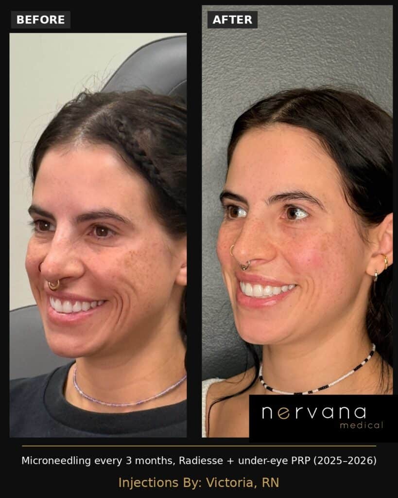 Before and After Image: Microneedling Before and After Sandy UT: Radiesse and PRP Results - left-front-oblique