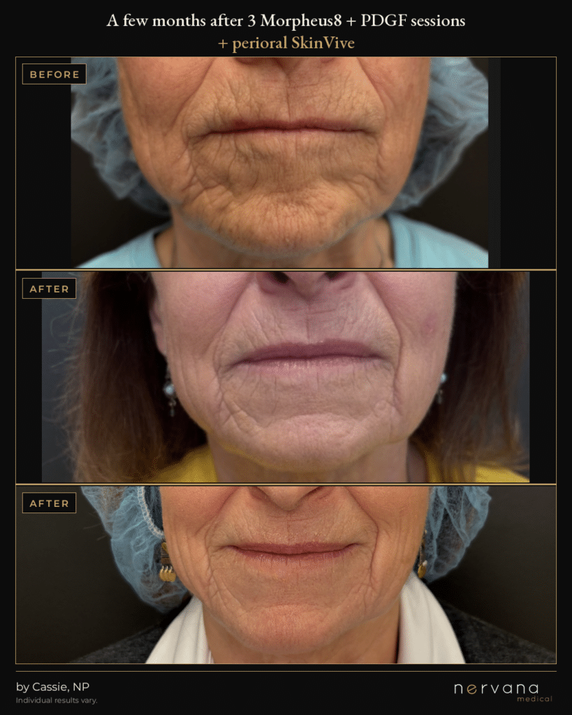 Before and After Image: Morpheus8 + PDGF and SkinVive Before and After | Sandy UT - front