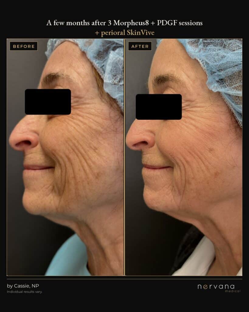 Before and After Image: Morpheus8 + PDGF and SkinVive Before and After | Sandy UT - left-side