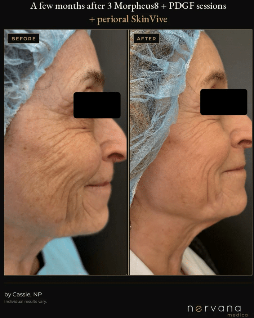 Before and After Image: Morpheus8 + PDGF and SkinVive Before and After | Sandy UT - right-side