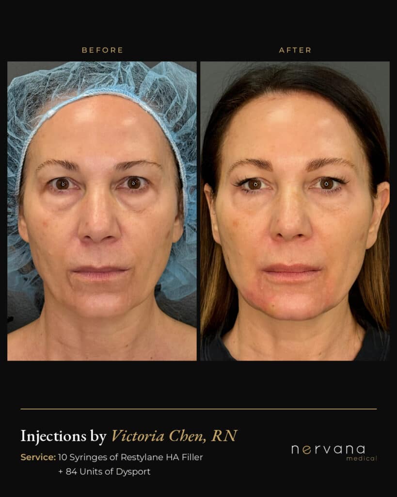 Before and After Image: Restylane + Dysport Full Facial Rejuvenation: Before & After - front