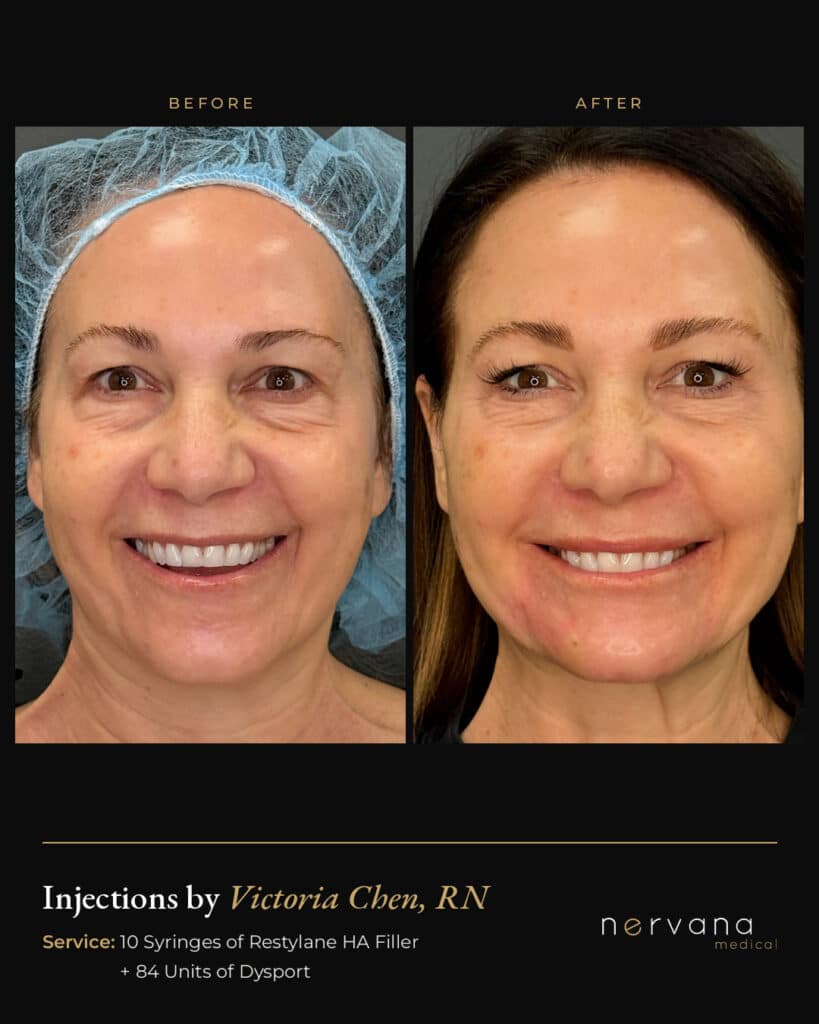 Before and After Image: Restylane + Dysport Full Facial Rejuvenation: Before & After - front