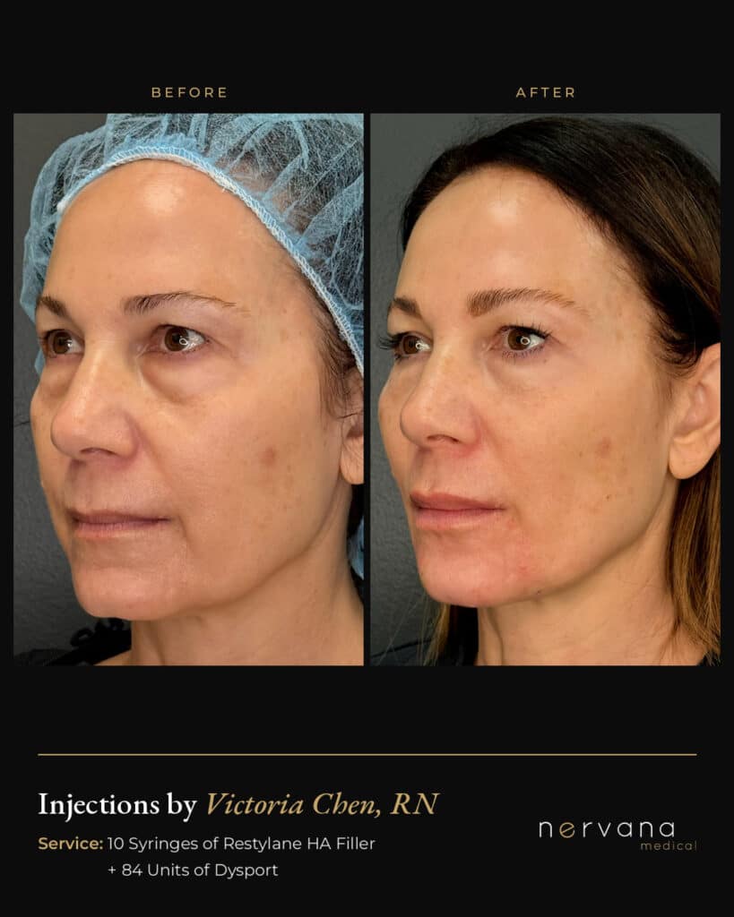 Before and After Image: Restylane + Dysport Full Facial Rejuvenation: Before & After - left-front-oblique