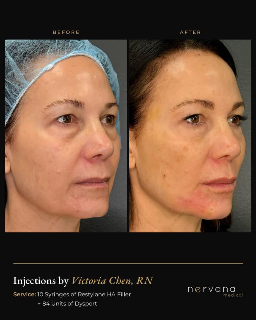 Before and After Image: Restylane + Dysport Full Facial Rejuvenation: Before & After - right-front-oblique