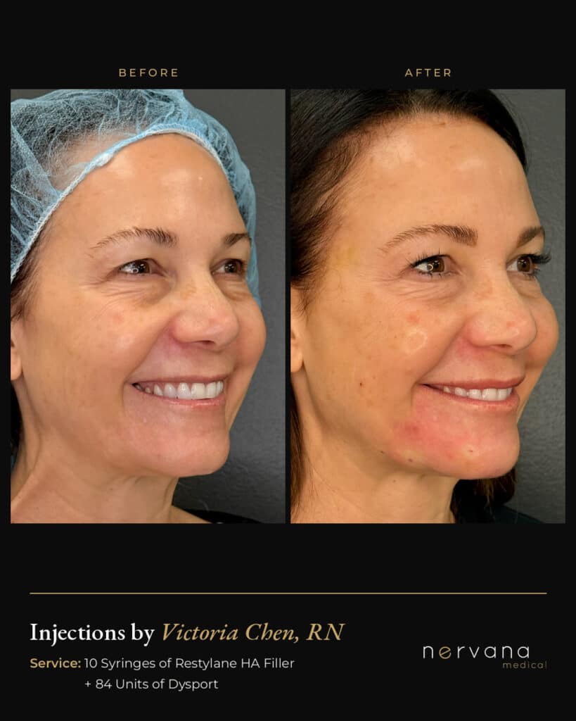 Before and After Image: Restylane + Dysport Full Facial Rejuvenation: Before & After - right-front-oblique