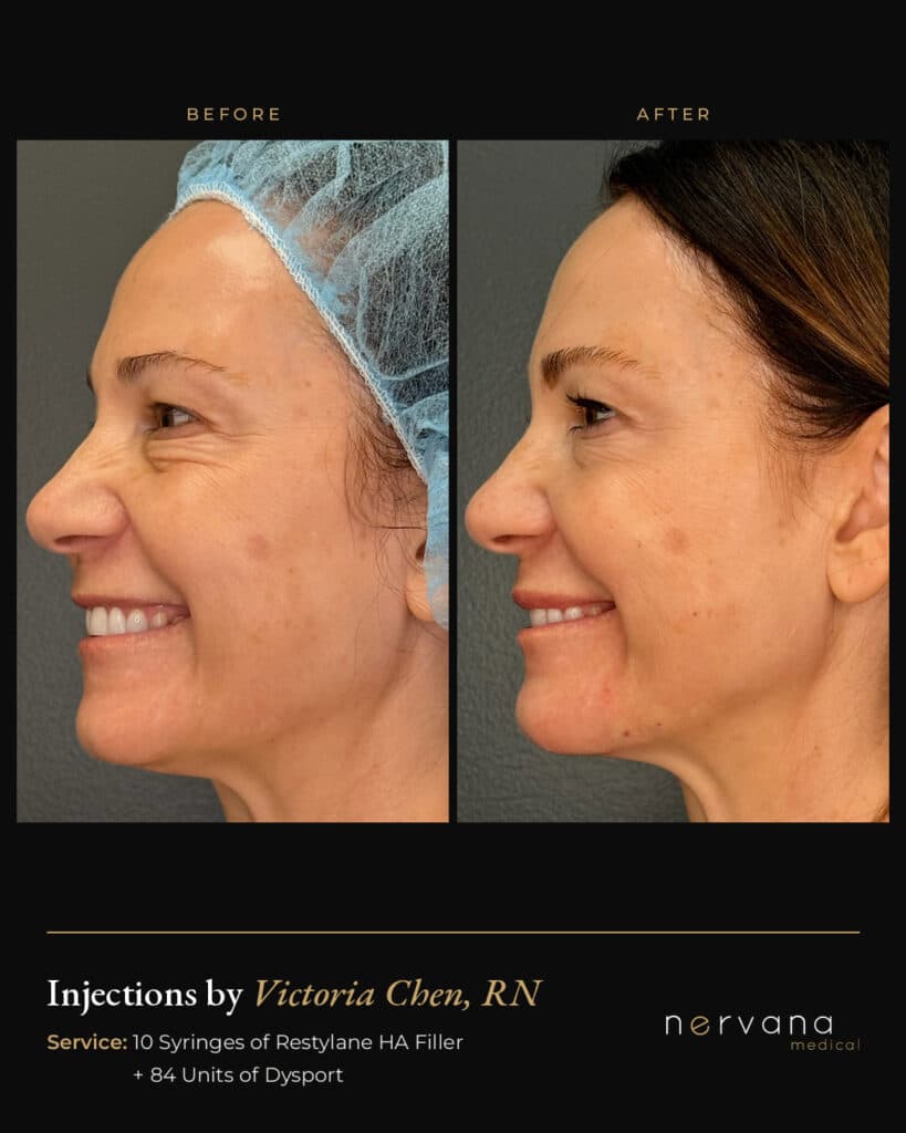 Before and After Image: Restylane + Dysport Full Facial Rejuvenation: Before & After - left-side
