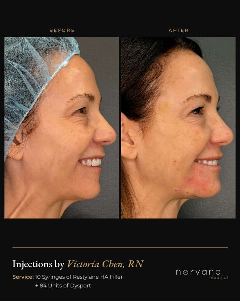 Before and After Image: Restylane + Dysport Full Facial Rejuvenation: Before & After - right-side