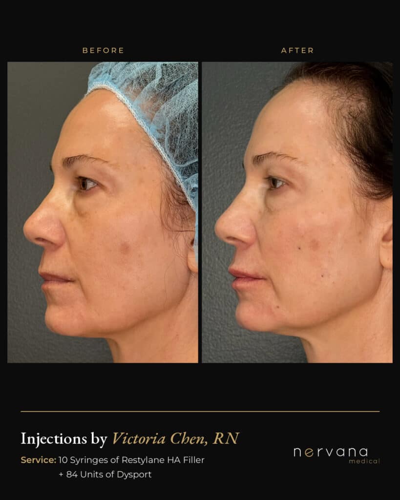 Before and After Image: Restylane + Dysport Full Facial Rejuvenation: Before & After - left-side