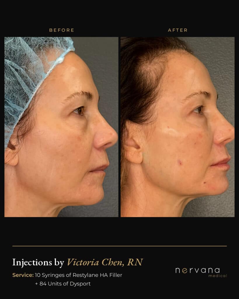 Before and After Image: Restylane + Dysport Full Facial Rejuvenation: Before & After - right-side