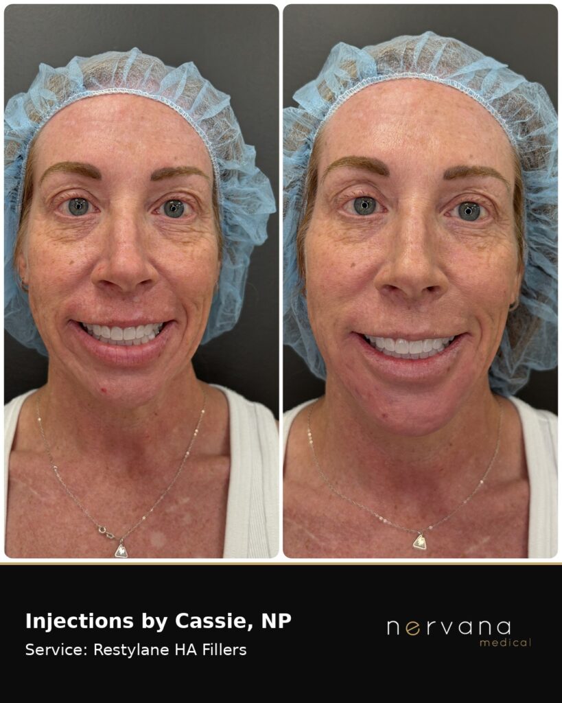 Before and After Image: Restylane Full Face Filler — Before & After | Sandy UT - front