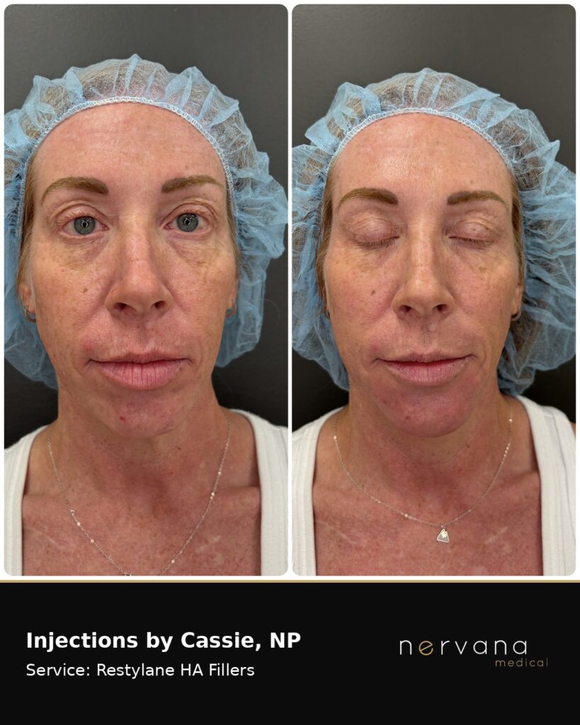 Before and After Image: Restylane Full Face Filler — Before & After | Sandy UT - front