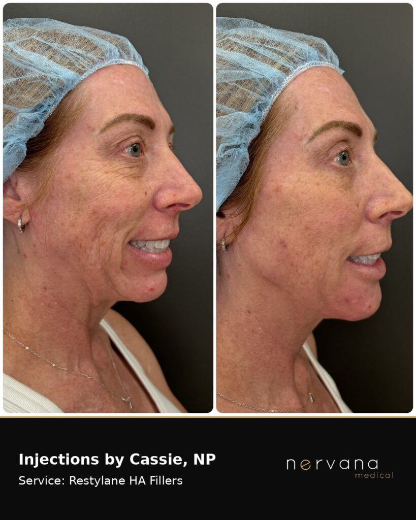 Before and After Image: Restylane Full Face Filler — Before & After | Sandy UT - right-front-oblique