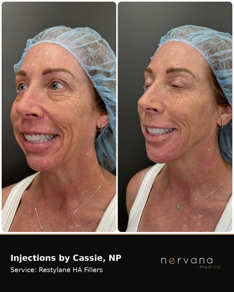 Before and After Image: Restylane Full Face Filler — Before & After | Sandy UT - left-front-oblique