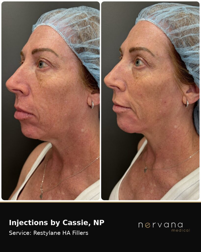 Before and After Image: Restylane Full Face Filler — Before & After | Sandy UT - left-front-oblique