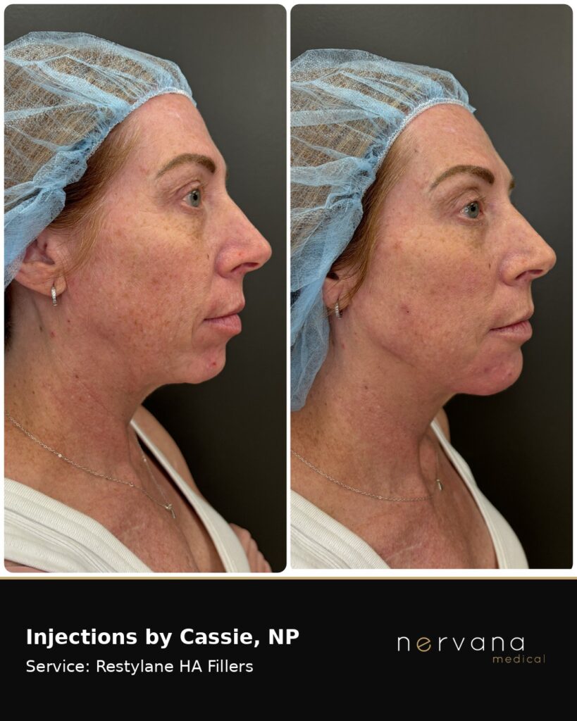 Before and After Image: Restylane Full Face Filler — Before & After | Sandy UT - right-side