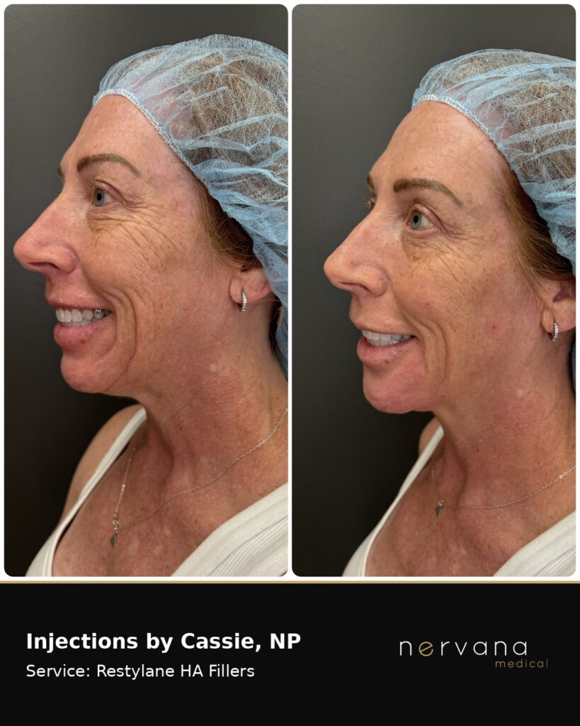 Before and After Image: Restylane Full Face Filler — Before & After | Sandy UT - left-side