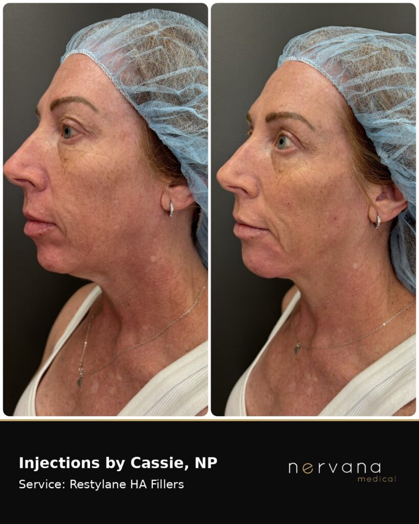 Before and After Image: Restylane Full Face Filler — Before & After | Sandy UT - left-side