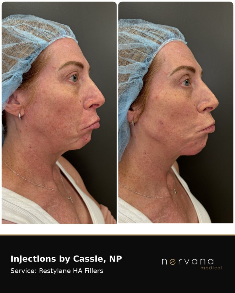 Before and After Image: Restylane Full Face Filler — Before & After | Sandy UT - other