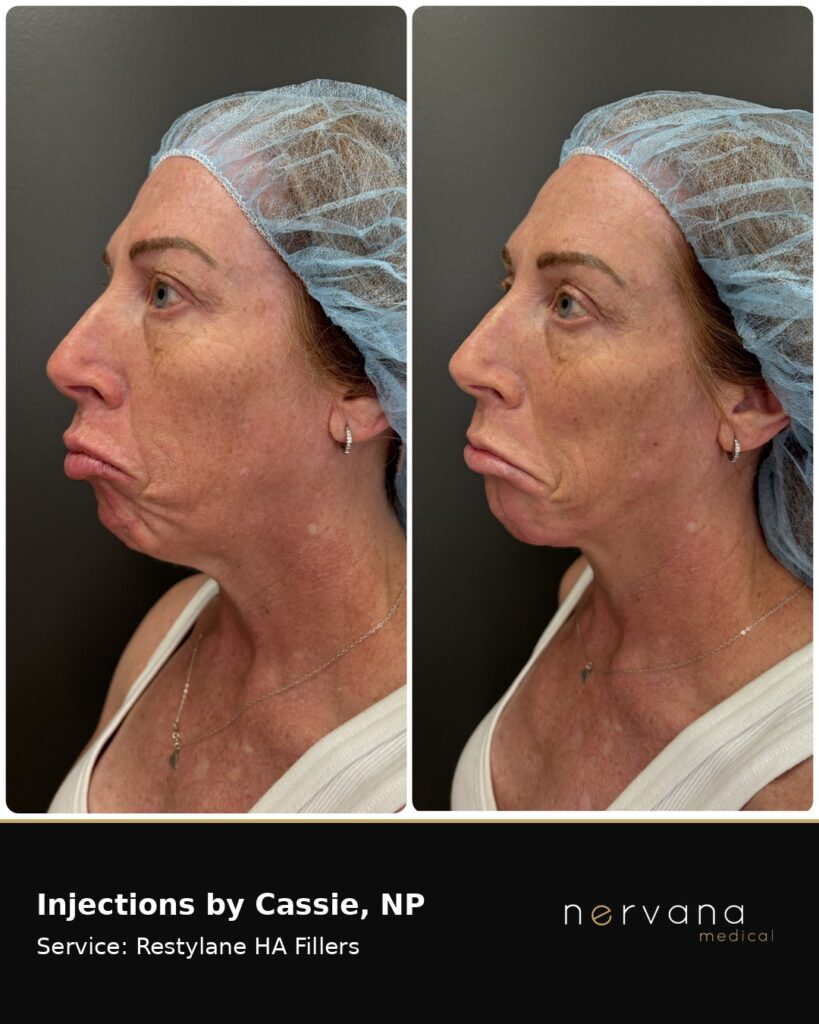 Before and After Image: Restylane Full Face Filler — Before & After | Sandy UT - other