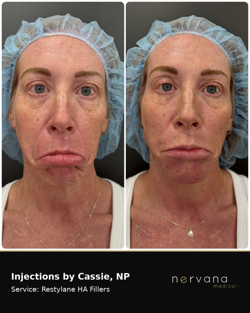 Before and After Image: Restylane Full Face Filler — Before & After | Sandy UT - other