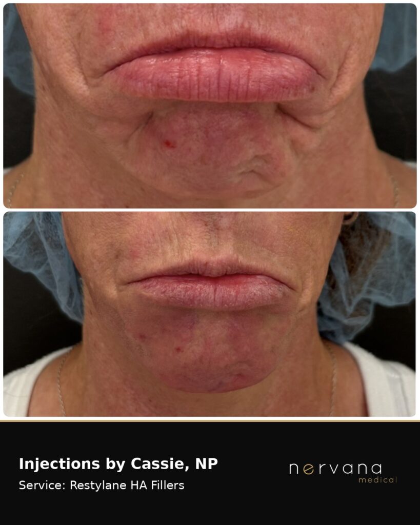 Before and After Image: Restylane Full Face Filler — Before & After | Sandy UT - other