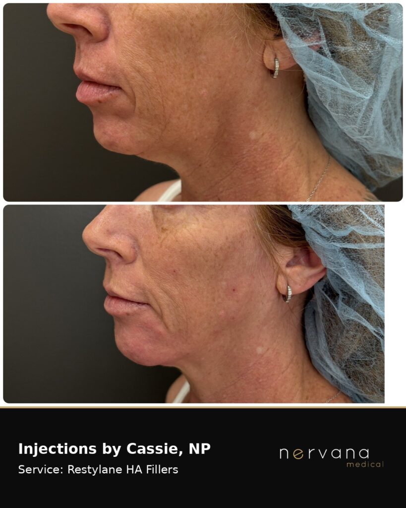 Before and After Image: Restylane Full Face Filler — Before & After | Sandy UT - other