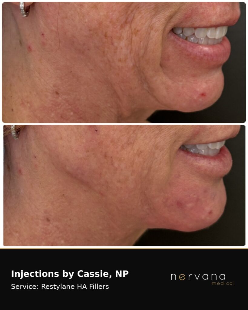 Before and After Image: Restylane Full Face Filler — Before & After | Sandy UT - other
