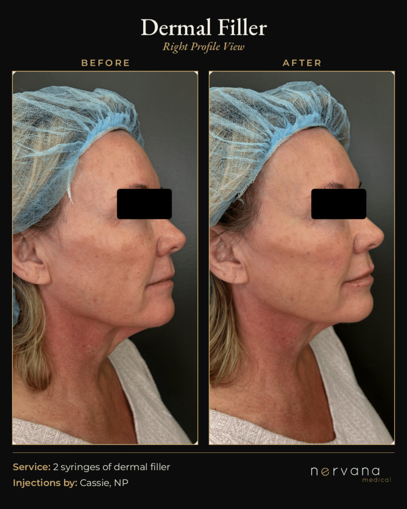Before and After Image: Dermal Filler Before and After Sandy UT: 2 Syringes, Natural Results - right-side