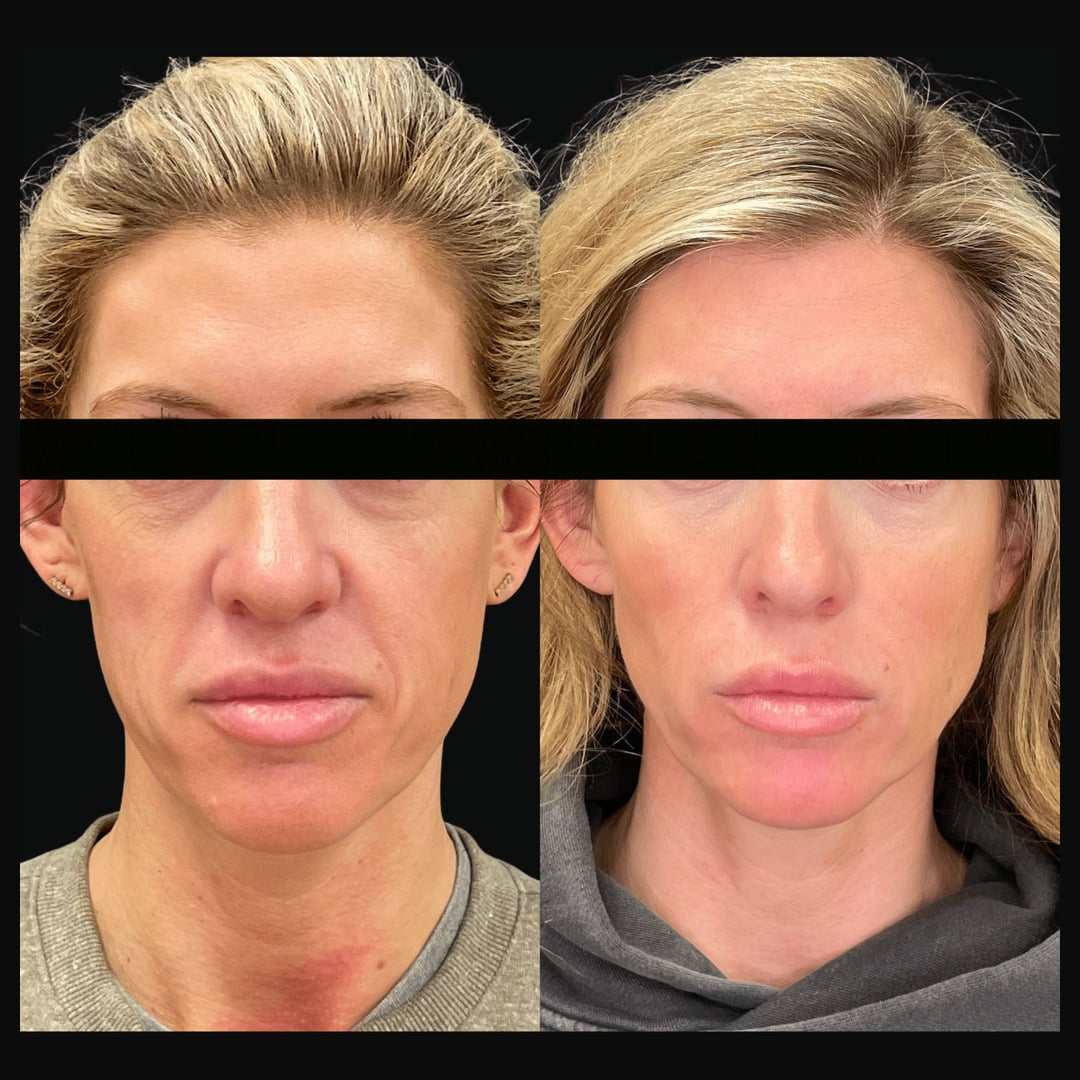 Sculptra and HA filler before and after